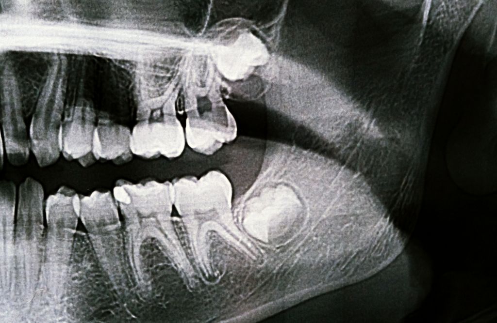 x ray image of jaw with teeth visible